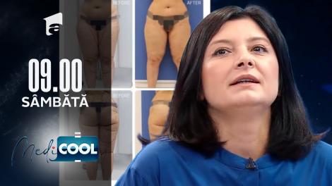 Medicool sezonul 1, 18 decembrie 2021. Ce este lipoedemul, boală confundată cu obezitatea