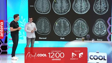 Medicool sezonul 5, 25 noiembrie 2023.  Cum ne afectează alcoolul creierul