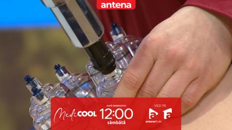 Medicool | Sezonul 10. Masajul cu ventuze: cum funcționează și c&acirc;nd poate ajuta