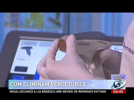 Numai de bine: Cum eliminăm vergeturile