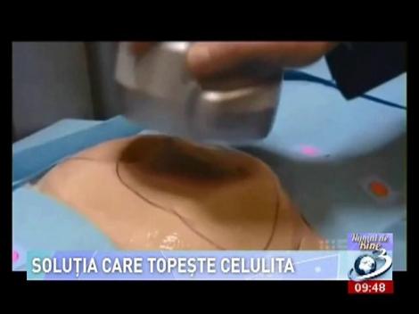 NUMAI DE BINE. Soluţia care topeşte celulita