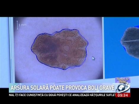 Numai de bine. Arsura solară poate provoca boli grave