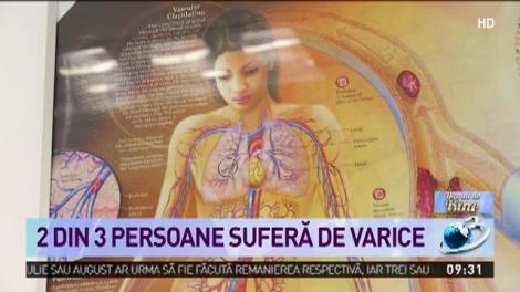 C&acirc;t de periculoase sunt varicele netratate