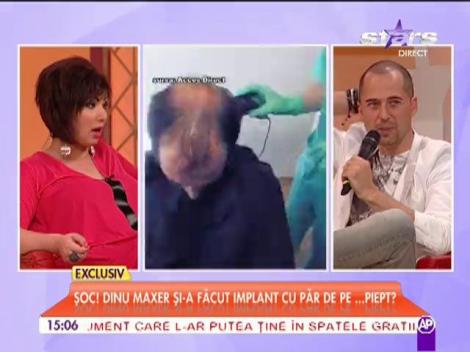 Dinu Maxer şi-a făcut implant cu păr de pe piept