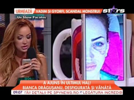 Bianca Drăguşanu, desfigurată şi vânătă