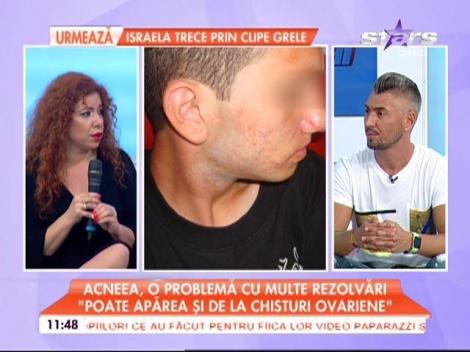VIDEO / C&acirc;teva trucuri care nu dau greş c&acirc;nd vine vorba de acnee! Renunţă să te speli pe păr cu capul &icirc;n jos! Află de ce