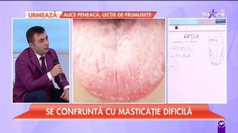 Limba, primul organ care te anunță că ești bolnav. Vârful limbii foarte roșu, probleme la inimă