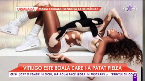 Winnie Harlow, modelul cu pielea în două culori