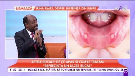 Ce boli grave ascund aftele: „Reprezintă un ulcer bucal”
