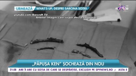 ”Păpușa Ken” sochează din nou. Bărbatul și-a scos patru coaste