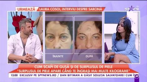 Cum scapi de gușă și de surplusul de piele. Cele mai bune sfaturi, direct de la specialiști: "Este sigura soluție"