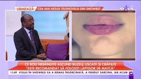 Ai buzele uscate şi crăpate mereu? Iată ce boli se ascund în spatele acestui simptom