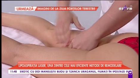 Lipoaspirația laser, una dintre cele mai eficiente metode de remodelare