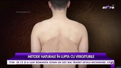 Trucuri pentru o piele netedă și catifelată. Metode naturale în lupta cu vergeturile