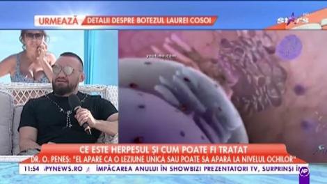 Tot ce trebuie să ştii despre herpes: ce este, de ce apare, dar şi cum să îl tratezi rapid! Medicul specialist îţi dă toate detaliile, în direct!
