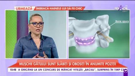 Spondiloza cervicală  - simptome, cauze şi tratament