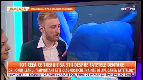Tot ceea ce trebuie să știi despre fațetele dentare