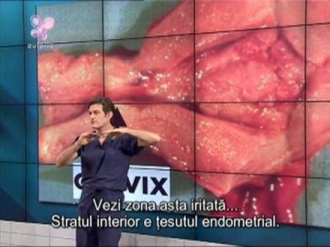 Dr. Oz: sangerarile neregulate, semn de cancer?
