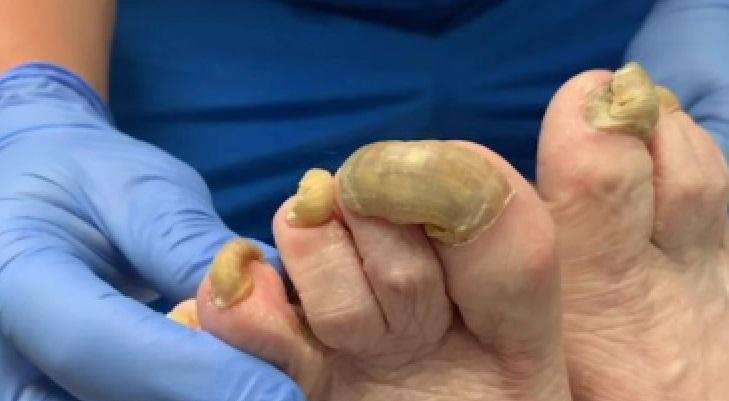 unghia de la picioare a devenit mai groasă din cauza ciupercii